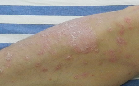 银屑病应该怎么进行预防