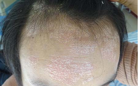 潍坊银屑病患者应该怎么预防遗传