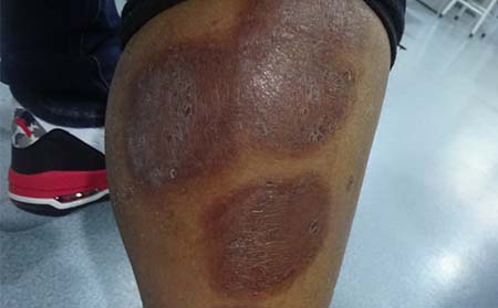 银屑病在潍坊应该怎么治疗