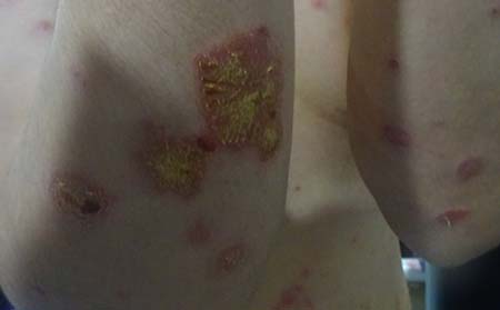 潍坊人患上银屑病的原因有什么