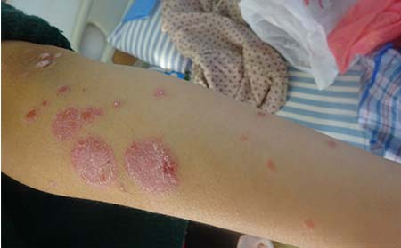 关节型银屑病在潍坊应该怎么护理