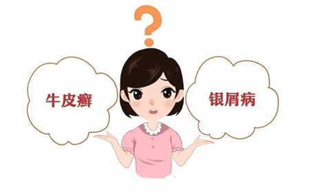 银屑病对潍坊患者有什么危害