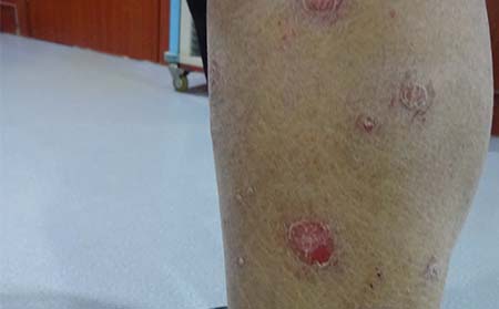银屑病对潍坊患者有什么危害