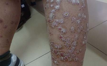 潍坊银屑病有什么危害