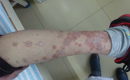 潍坊银屑病应该怎么预防