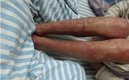 潍坊银屑病应该怎么进行治疗