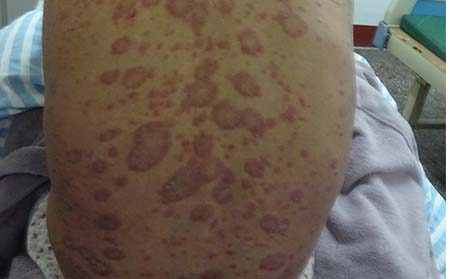 潍坊发生银屑病的原因有什么