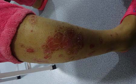 潍坊银屑病应该怎么护理