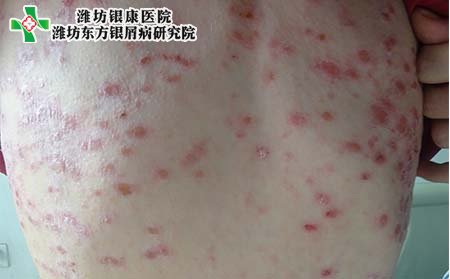 银屑病症状,得银屑病什么症状