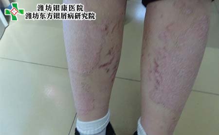 牛皮癣初期症状,初期牛皮癣的症状