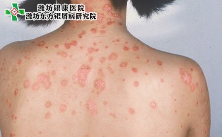 女性牛皮癣遗传,女性牛皮癣遗传吗