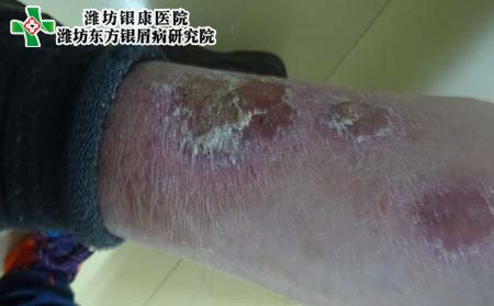 牛皮癣危害,牛皮癣带来的危害