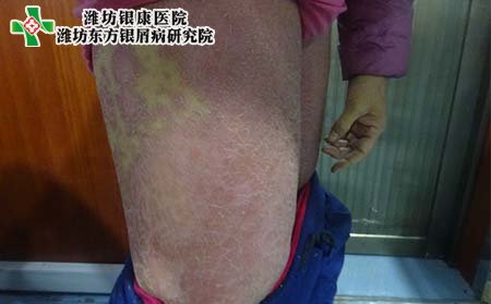 潍坊银屑病医院,潍坊有几家银屑病医院