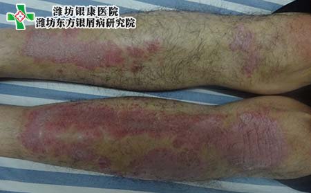 牛皮癣危害,牛皮癣都有什么危害