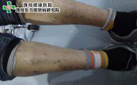 腿部银屑病症状,腿部银屑病症状什么样
