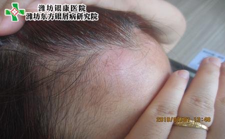 山东银屑病医院:牛皮肤癣有什么药可以治疗