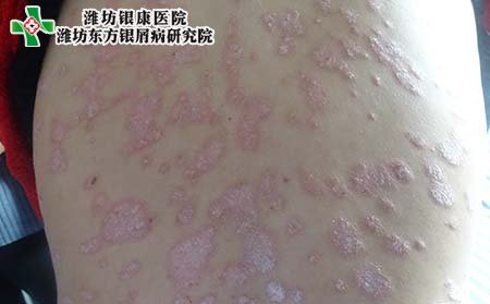 怎样治牛皮癣,临床治牛皮癣方法