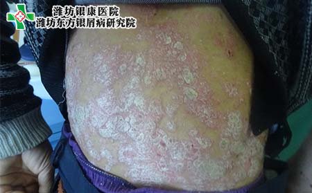银屑病症状,患银屑病什么症状