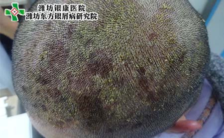头部银屑病症状,初期头部银屑病症状