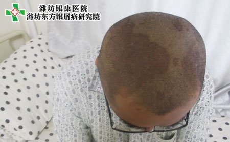 头部牛皮癣危害,怎样避免牛皮癣的危害
