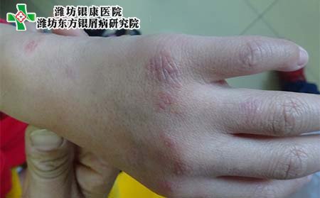 手部银屑病症状,手上银屑病什么样