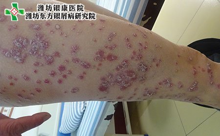 银屑病症状表现,得银屑病有什么症状