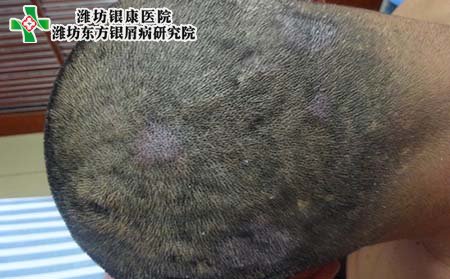 头部银屑病好转症状,头部银屑病好转症状
