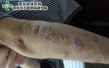 牛皮癣病因,女性患牛皮癣原因