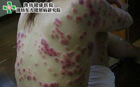 牛皮癣病因,女性患牛皮癣的原因