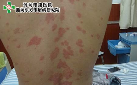 牛皮癣症状,背部牛皮癣的症状