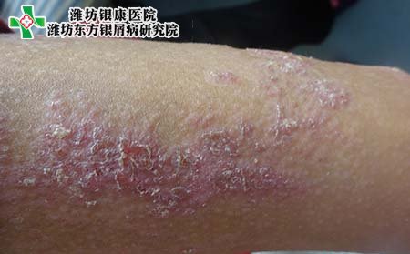 牛皮癣症状,牛皮癣表现的症状