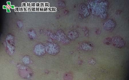 银屑病病因,引起银屑病的原因